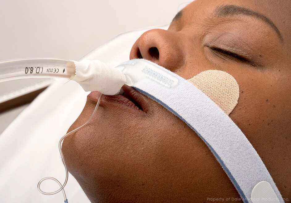 Dale Stabilock Endotracheal Tube Holder