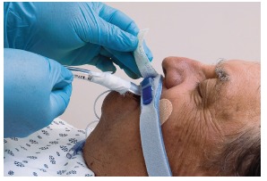 Dale BreezeLock® Endotracheal Tube Holder - Image 2